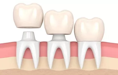 Dental Crowns in Abu Dhabi