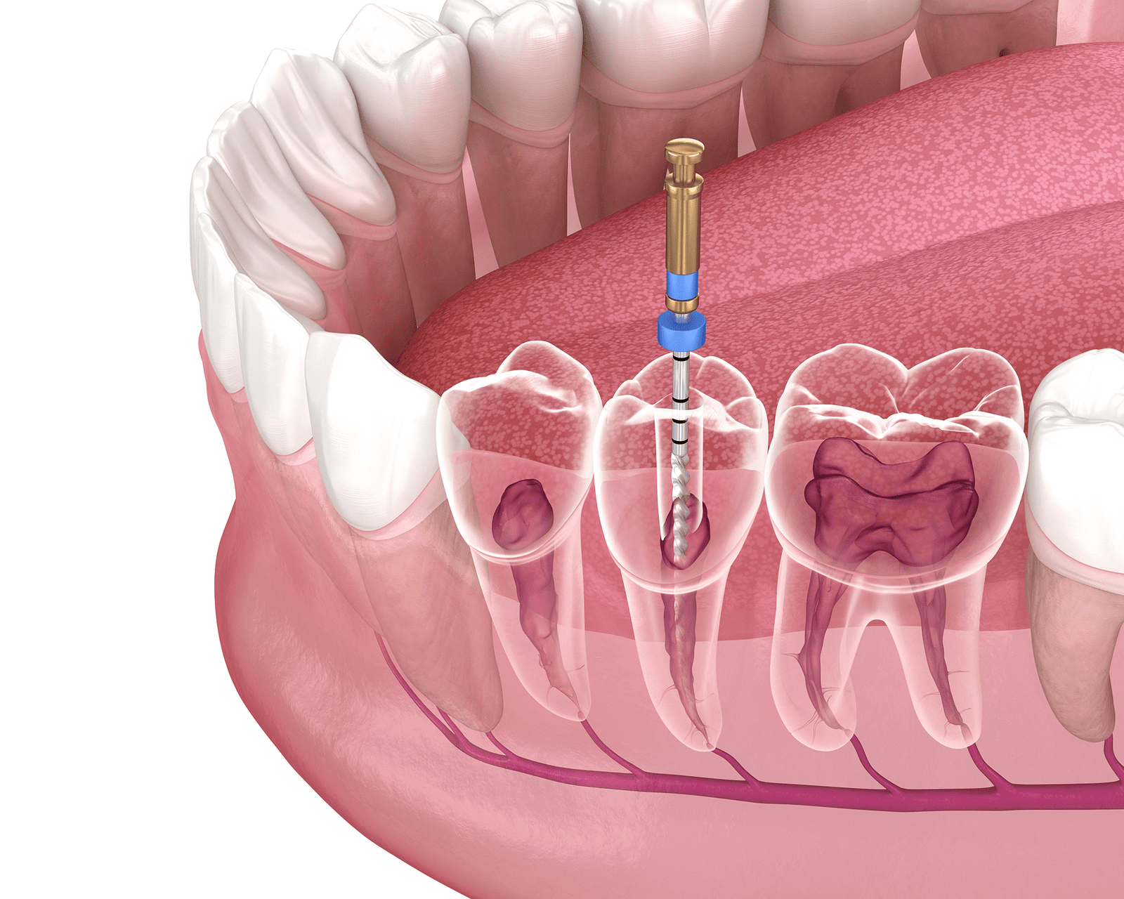 root canal treatment in abu dhabi
