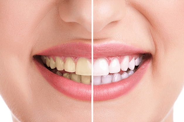 Teeth Whitening Clinic Teeth Whitening Clinic Near Me
